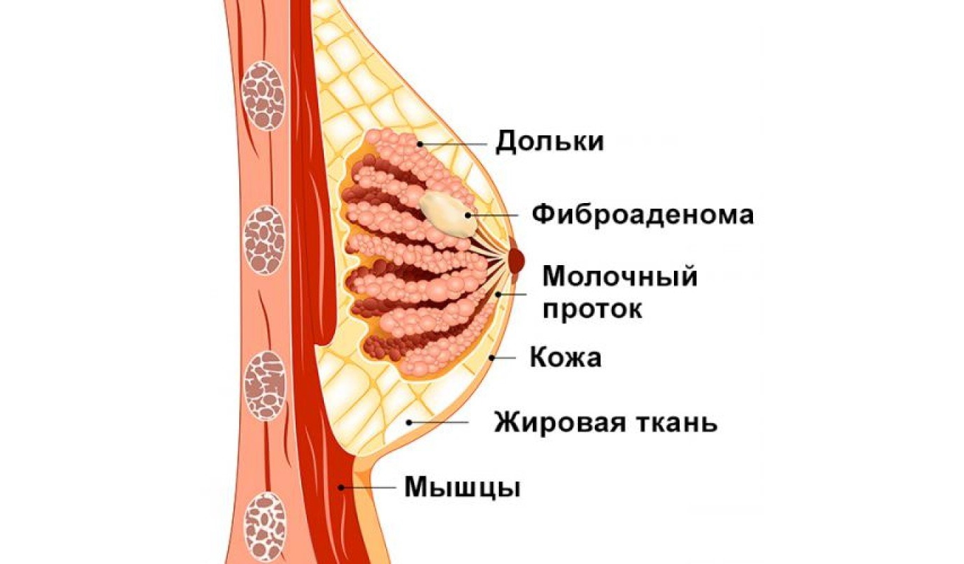 внутрипротоковая папиллома молочной железы фото